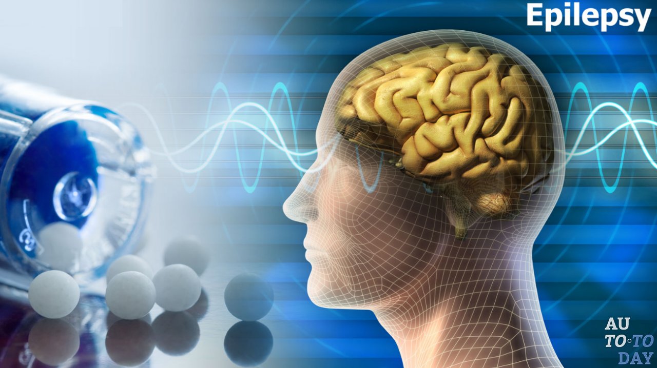 Эпилепсия Эпилепсия